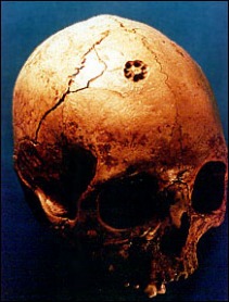 A skull with multiple small trephaning holes that form a ring