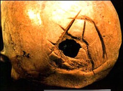 A skull with a large trephaning hole