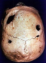 An ancient skull with trephaning holes
